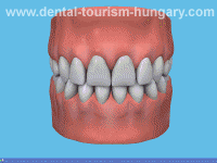 Root kanal treatment - Dentistry in Hungary