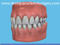 Dental problem of gum disease - Dentistry Hungary
