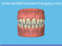 How to clean a dental crown - Dentistry Hungary