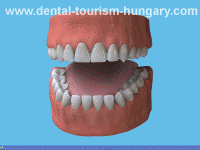 Using a Superfloss - Dental Tourism Hungary
