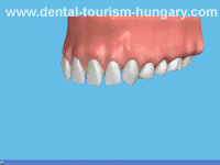 The way to take an impression - Dental Tourism Hungary