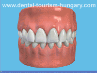 Dental bridges for baraign prices in Hungary