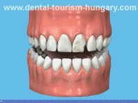 High quality dental crowns for low costs in Hungary - offered by Dental Tourism