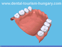 Dentures in Hungary - High quality, low prices!