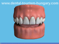 Dentures Relining - Dental Tourism Hungary