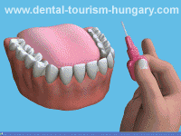 Use an inderdental brush between the teeth to remove debris and plaque!