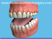 Tooth cleaning with Minifloss - Dental Tourism Hungary
