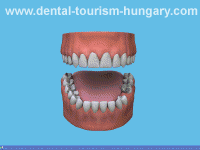 Preparation of a dental bridge - Dental Tourism Hungary