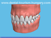 Dental implant and superstructure with bar, implant-supported bridge, implant-supported denture - Dental Tourism Hungary