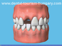 Get low-cost dental implants! - Dental Tourism Hungary - Highest Quality and top Prices!