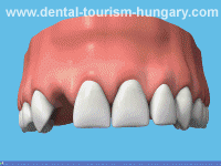 Temporary crown on an Implant - Dental Implantology in Hungary - Top Prices!