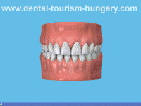 Fissure sealant