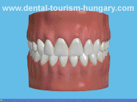 Surgical extraction of wisdom tooth