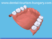 Denture fixative