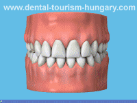 Dentures, dental prosthesis in Hungary