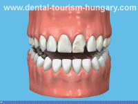 Dental crowns in Hungary Mosonmagyaróvár