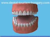 Cleaning of dental bridges in Hungary Mosonmagyaróvér