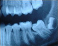 Wisdom teeth
